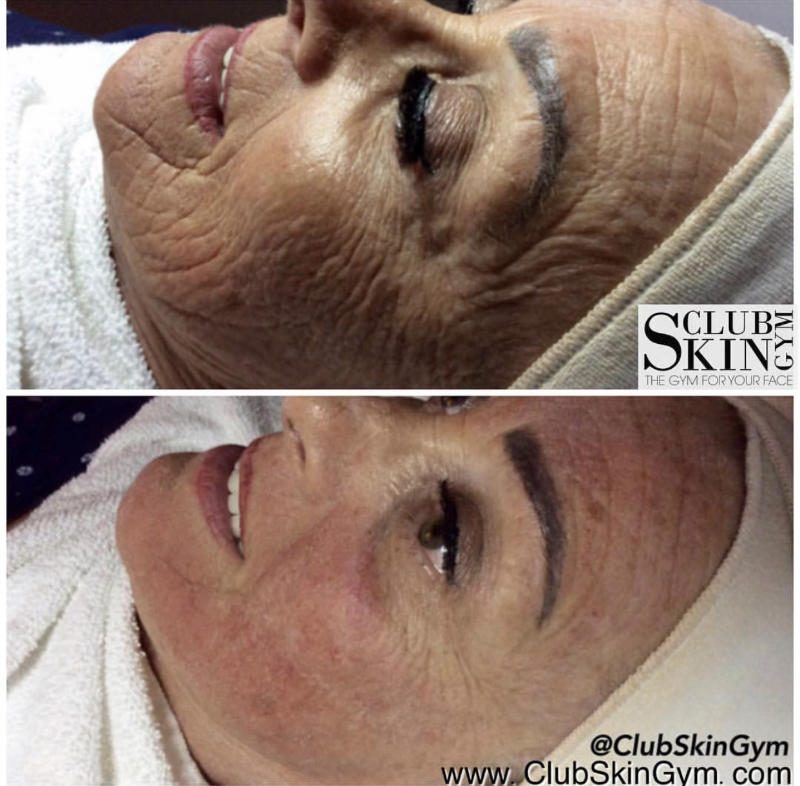 Before and after of a client's cheek and eye area with visibly smoother lines