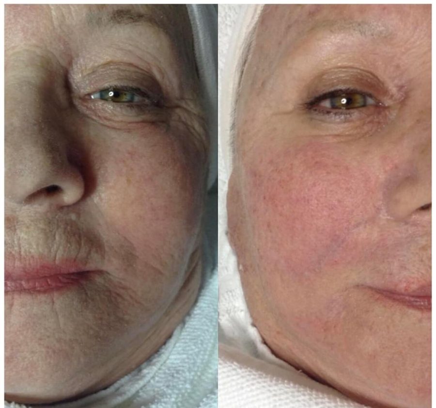 Before and after of a client's face with smoother texture around the eye and mouth