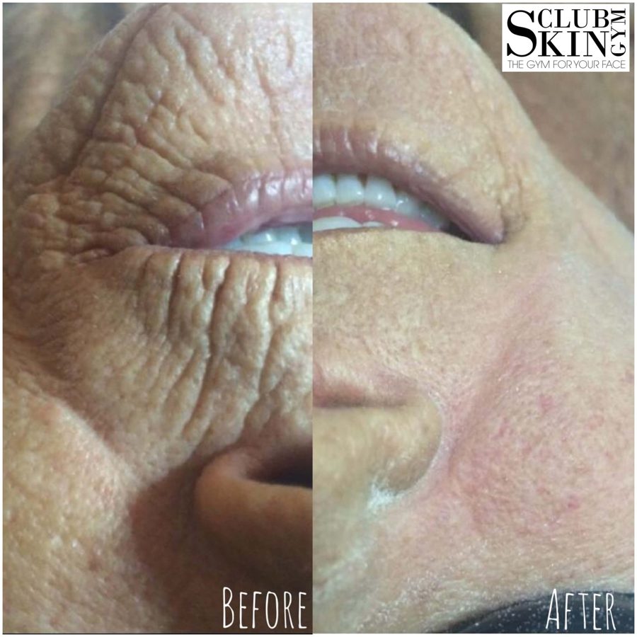 Before and after of lines around a client's mouth, visibly softened