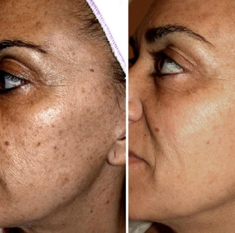 Before and after of a client's cheek with sun spots and pigmentation visibly faded