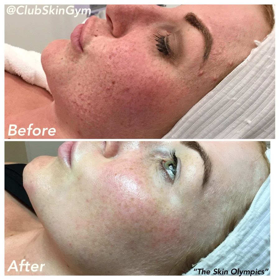 Before and after of a client's cheek with clearer, more even texture