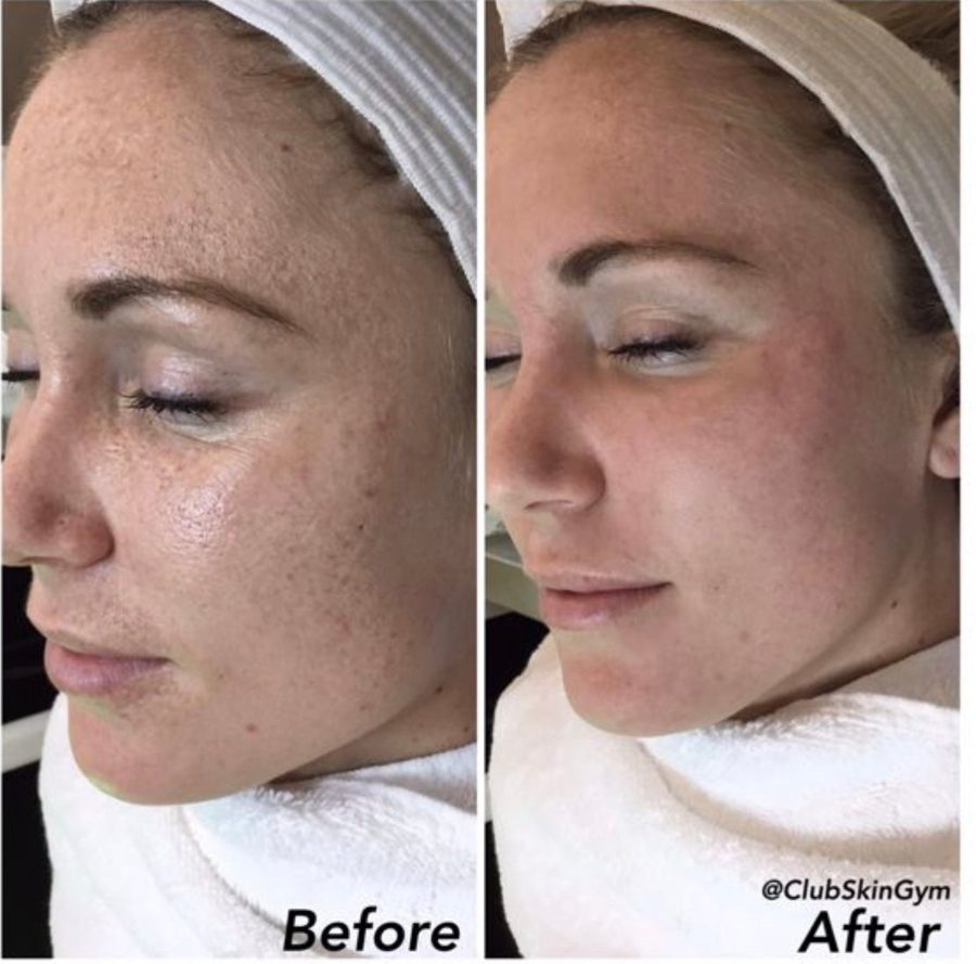 Before and after of a client's cheek with more even tone
