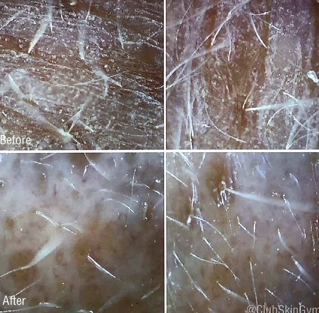 Microscopic images of a client's skin: before, with dry flaky build-up on the surface; after one treatment, visibly clearer and smoother